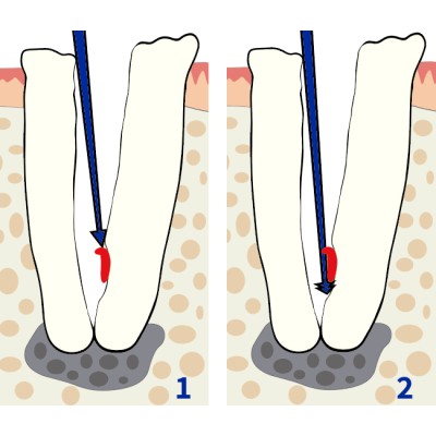 Gutta Percha Removal spear by YDM