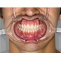 Cheek Retractor with Extended Tabs 