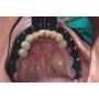 Universal Implant Guide (2pcs)